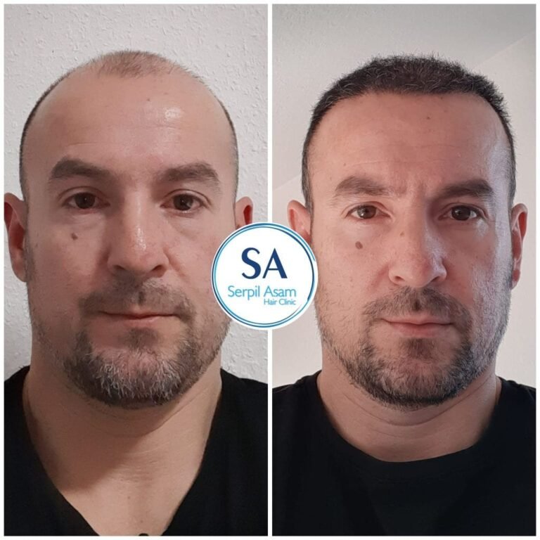 Presaditev las – rezultat pred in po pri pacientu klinike Serpil Asam (16)
